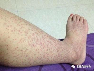 过敏性紫癜可以吃瓜吗,瓜类食物的适宜与禁忌